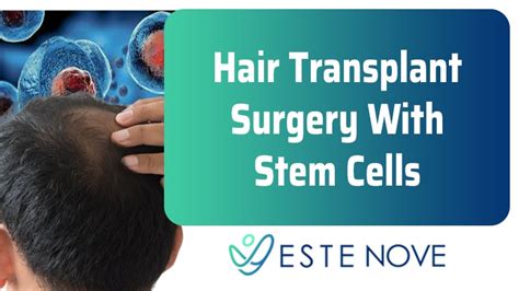 The hair stem cell transplantation (hst) method involves removing the entire hair follicle, as well as a number of stem cells in the donor area. Hair Transplant Surgery With Stem Cells | EsteNove Hair ...
