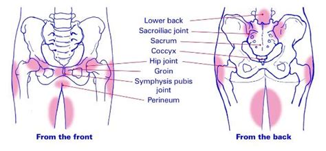 Pelvic Girdle Pain Chronic Pelvic Pain