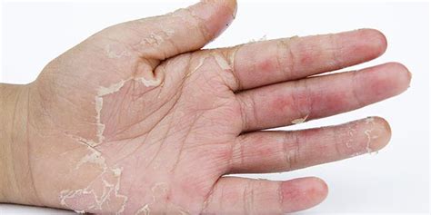 Home Remedy To Get Rid Of Hand Skin Peeling Home Remedies For Skin