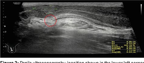 Figure 1 From Role Of Penile Doppler As A Diagnostic Tool In Penile