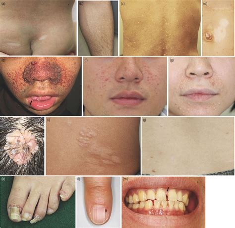 Tuberous Sclerosis Shagreen Patch