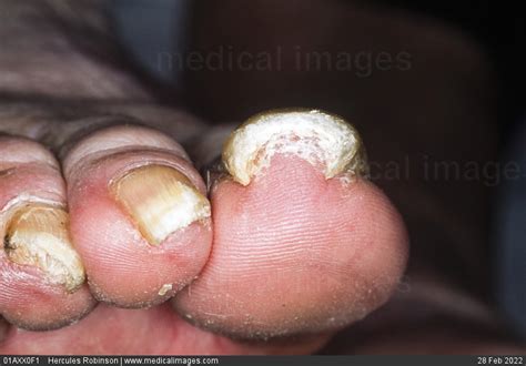 Stock Image Dermatology Fungal Nail Infection Thickened Discolored And