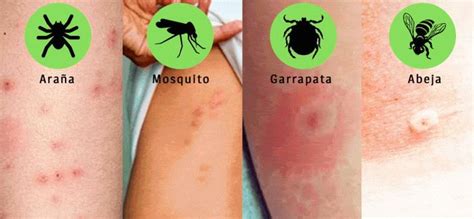 Infección intestinal sintomas y causas. Picadura de garrapata en niños; ¡Los mejores remedios ...