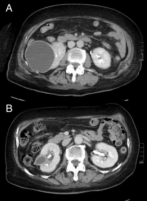 Contrast Enhanced Computed Tomography Ct Images Of The Abdomen On