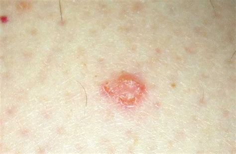 I Have A Rashes On My Leg Quad And Inner Thigh That Are Round