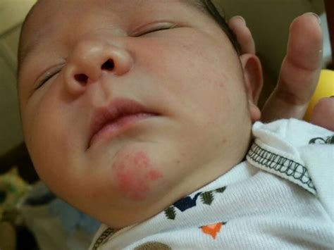 Newborn Face Rash Pic Included Update With Pic Added Babycenter