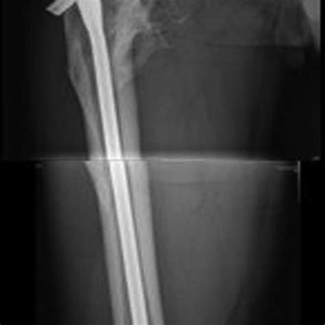 Patient With Femoral Intertrochanteric Fracture Accepted Intramedullary