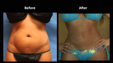 Liposuction Of The Female Abdomen Before And After Pictures Performed