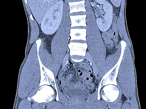 Abdominal Ct Scans Definition Uses Picture And More