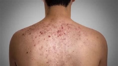 How To Get Rid Of Bacne Back Acne Scars Fast Remedies At Home Back