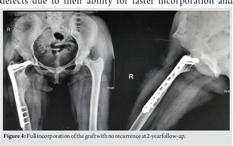 Pdf A Case Report Of Aneurysmal Bone Cyst With Pathologic Fracture Of