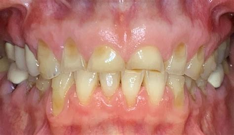 Dental Case Study 42 North Shore Restorative And Implant Dentistry