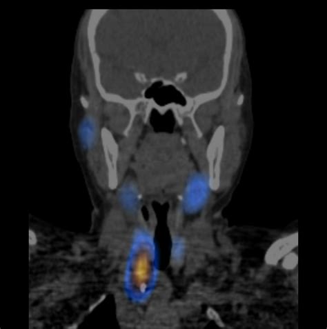 Hyperparathyroidism Parathyroid Adenoma Image