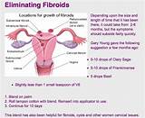 Holistic Treatment For Fibroid Tumors Photos