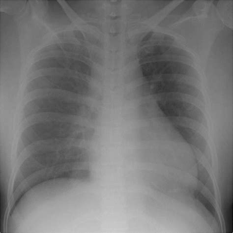 Clinically Suspected Acute Myopericarditis With Cardiac Tamponade