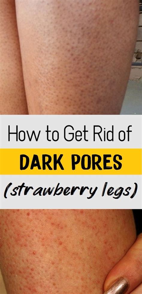 How To Get Rid Of Strawberry Legs In 2020 Strawberry Legs Dark Pores