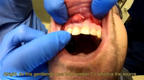 Removing A Maxillary Cyst Youtube