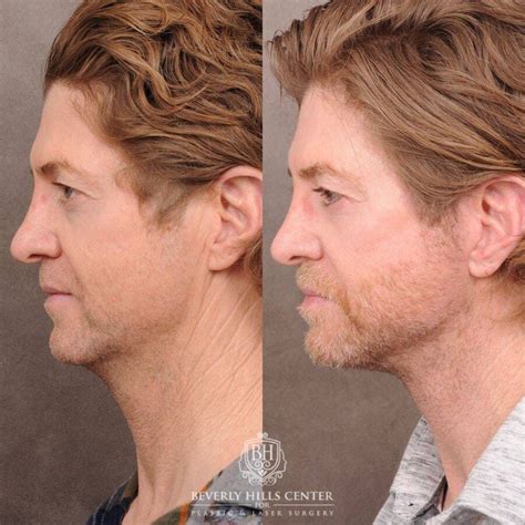 Cosmetic Plastic Surgery Procedures For Men Beverly Hills Ca