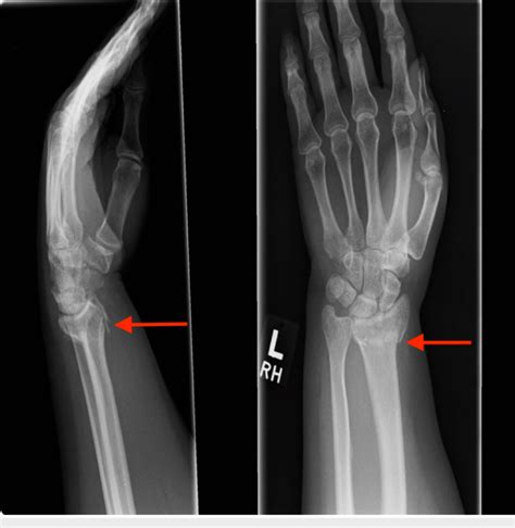 Comminuted Extra Articular Fracture Pdf The Treatment Of Severely