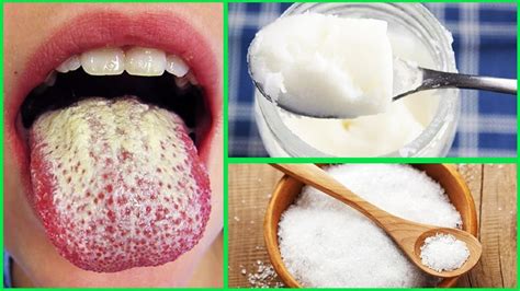 How To Get Rid Of Oral Thrush With This 10 Simple Home Remedies Youtube