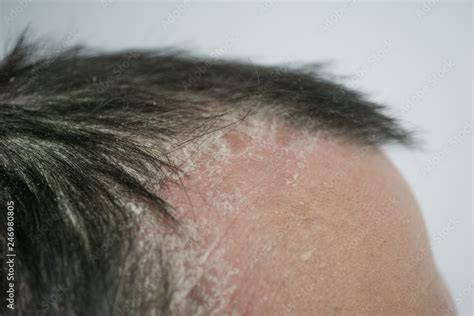 Psoriasis On The Hairline And On The Scalp Close Up Dermatological