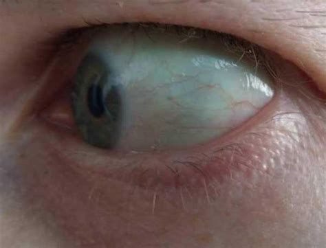 Greyish Spot In My Eye Ask The Eye Doctor Webeyeclinic