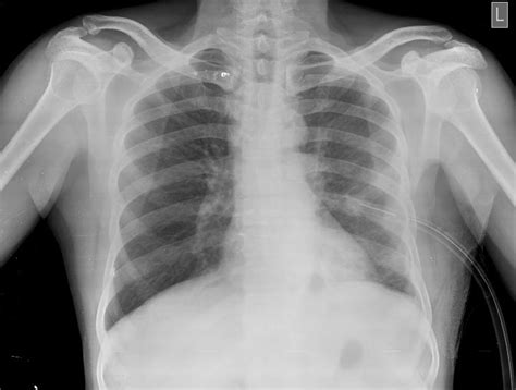 Abnormal Chest X Ray Images