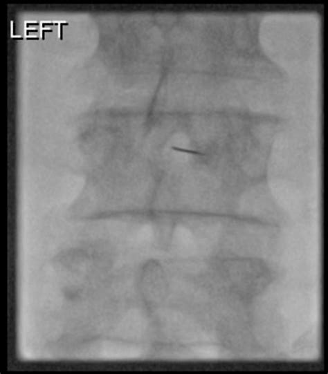 Fluoroscopy Guided Lumbar Puncture Pacs