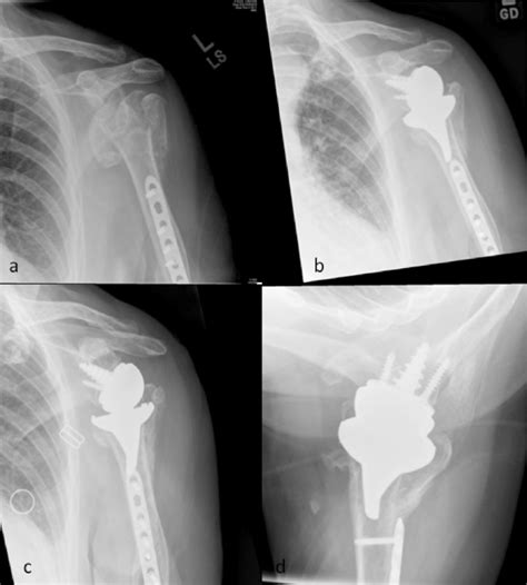 A Comminuted Fracture Of The Proximal Humerus With A Previous Humeral