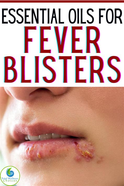 Top 5 Essential Oils For Fever Blisters Cold Sores In 2020 Blister