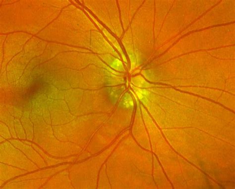 Figure Fundus Photo Revealing Pseudo Papilledema From Optic Nerve