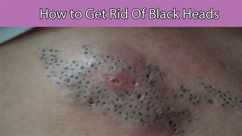 Use a readymade one that can be bought at the drugstore. How to Get Rid of Blackheads -How to Get Rid of Blackheads ...