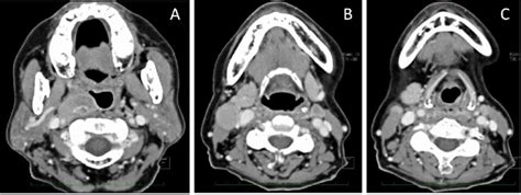 A Retropharyngeal Node Metastasis Involved The Right Internal Carotid