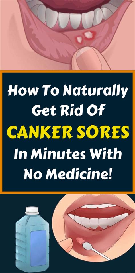 How To Cure Canker Sores And Mouth Sores Remedy Day