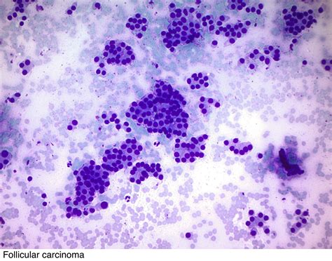 Pathology Outlines Follicular