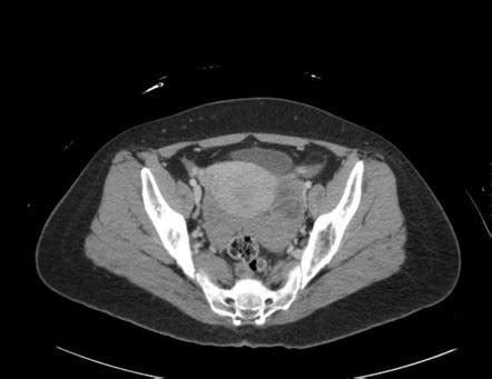 Ruptured Corpus Luteal Cyst Radiology Case Radiopaedia Org