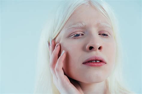 Albinismo Ocular Qué Es Y Cómo Se Trata Wikivision
