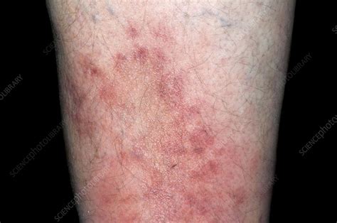 Cellulitis Of The Leg Stock Image C0111656 Science Photo Library