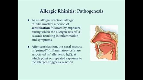 Allergic Rhinitis Crash Medical Review Series Youtube