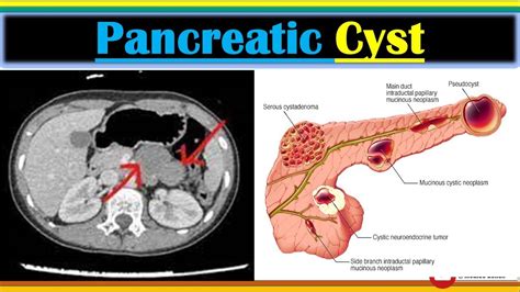 Pancreatic Cysts Medicine Types Of Pancreatic Cysts Treatment