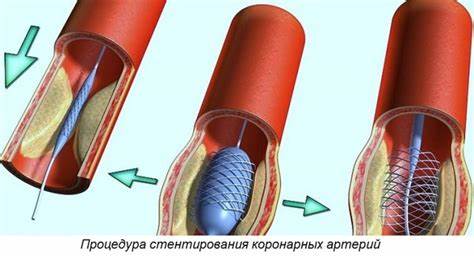 Диета инфаркт миокарда стентирование