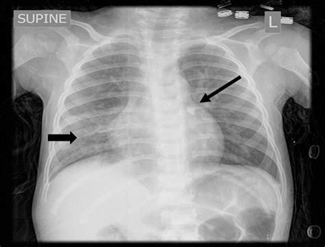 The Wandering Calcified Lung Nodule The Journal Of Pediatrics