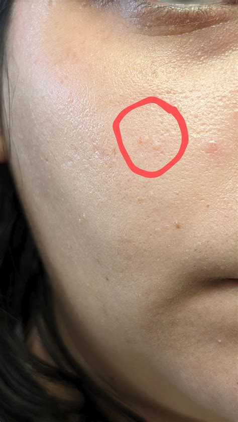 Ive Had These 2 Acne Looking Bumps For Over A Year Wtf Are They R