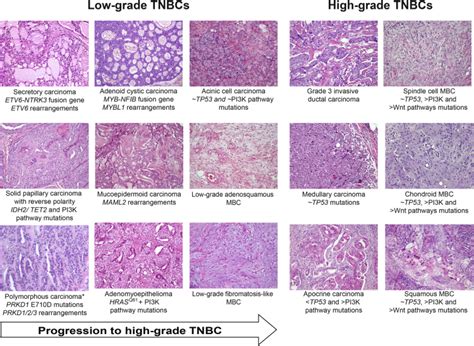 The Spectrum Of Triple Negative Breast Disease The American Journal