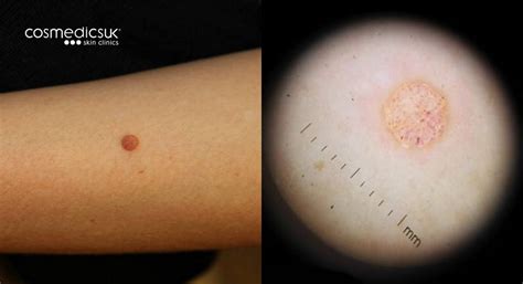 Mole Clinic Mole Checks And Screening Cosmedics Skin Clinics