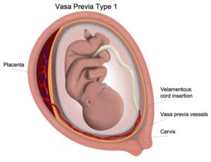 Complete placenta previa and marginal placenta previa. Vasa Previa - Los Angeles Fetal Surgery