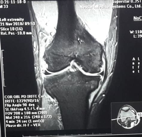 Mri Of The Knee Coronal View Shows Multi Ligament Knee Injury