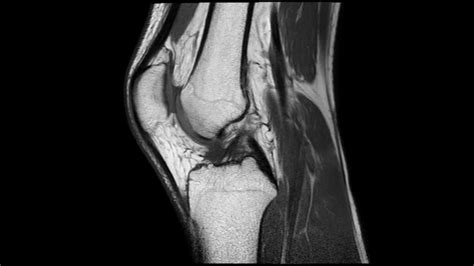 Mri Of A Normal Knee Complete Mri Examination Youtube