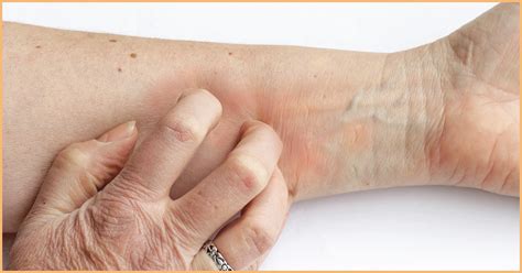 Manage Excessive Dry Skin And Itchy Xerosis In Elderly Delfina Skin™