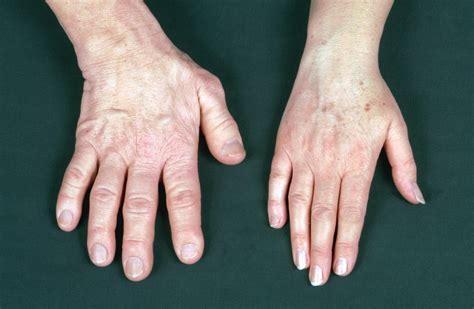 Acromegaly Outlook Improves With Better Diagnostics And Treatment